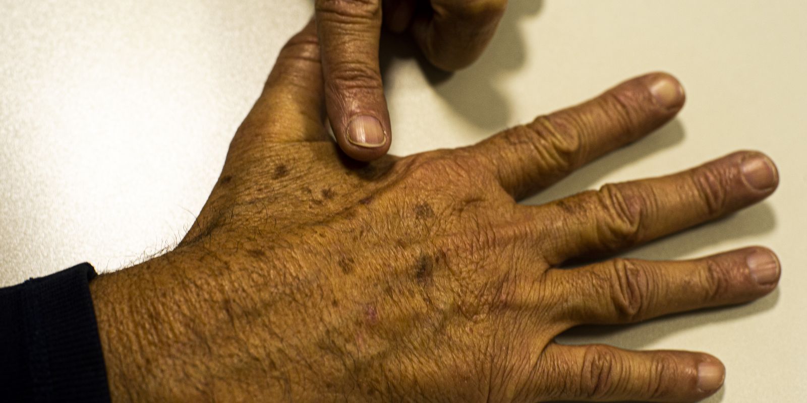 Desinformação sobre câncer de pele afeta diagnóstico, diz instituição